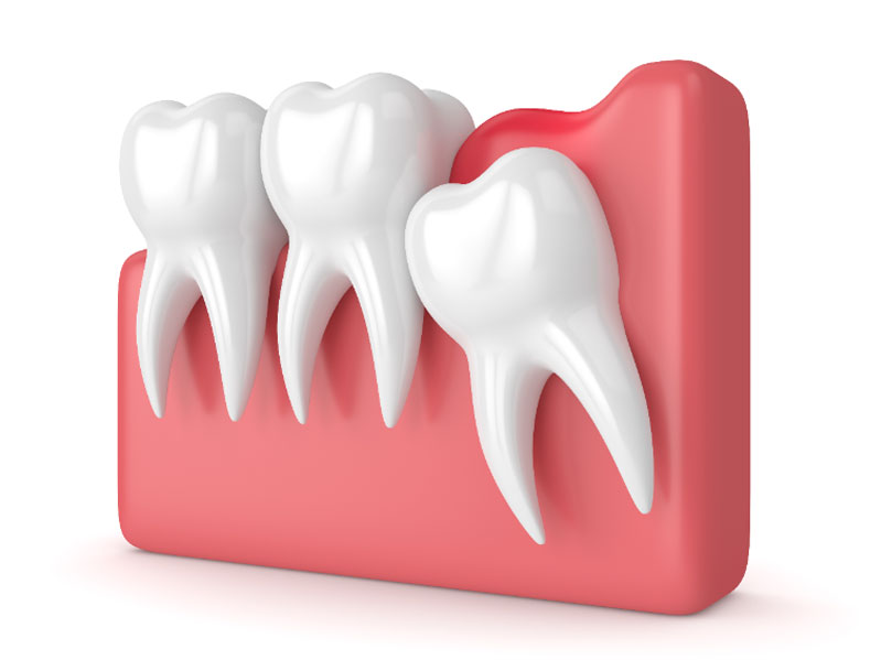 Glenn Smile Center's anatomical diagrams of wisdom tooth extraction enhance patient comprehension of dental health, an integral part of their philosophy of providing comprehensive dental care.