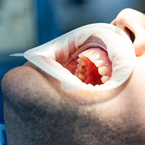 A man's mouth is open during a wisdom tooth extraction.