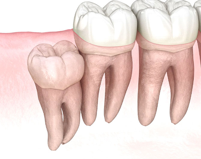 A 3D image of a tooth with a crown on it, demonstrating the need for wisdom teeth removal.