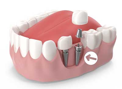 Dental implant example showcased at the Glenn Smile Center