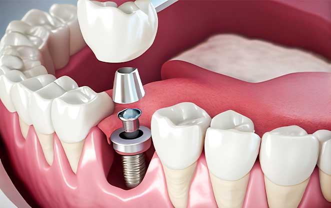 Glenn Smile Center's dental implant sample on show