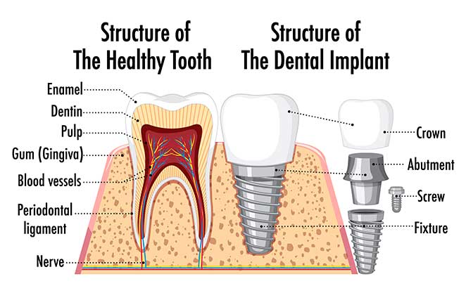 Glenn Smile Center exhibits a dental implant diagram