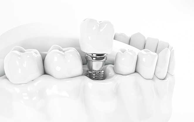 Glenn Smile Center features a mockup of a dental implant