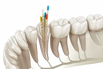 An illustrative 3D mockup representing the general dentistry services offered at Glenn Smile Center.