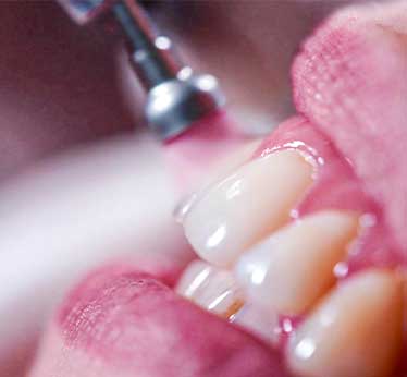 Procedure of  teeth cleaning at Glenn Smile Center.