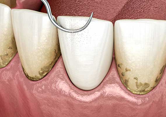 Experience the precision of Glenn Smile Center's teeth cleaning service through this 3D mockup.