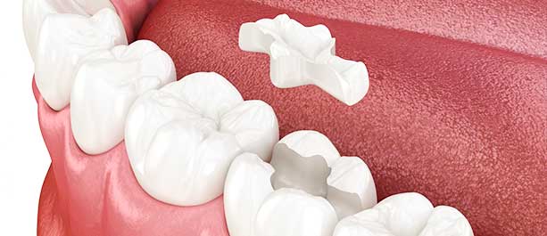 Explore the model display mockup of dental fillings found at Glenn Smile Center.
