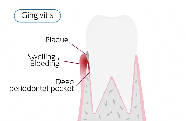 Illustration depicting periodontal disease provided by Glenn Smile Center.