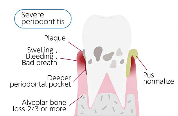 Visualization of gum disease progression, courtesy of Glenn Smile Center.