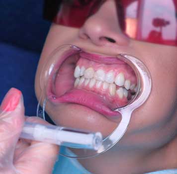 Remarkable teeth whitening provided by Glenn Smile Center's dental specialist.