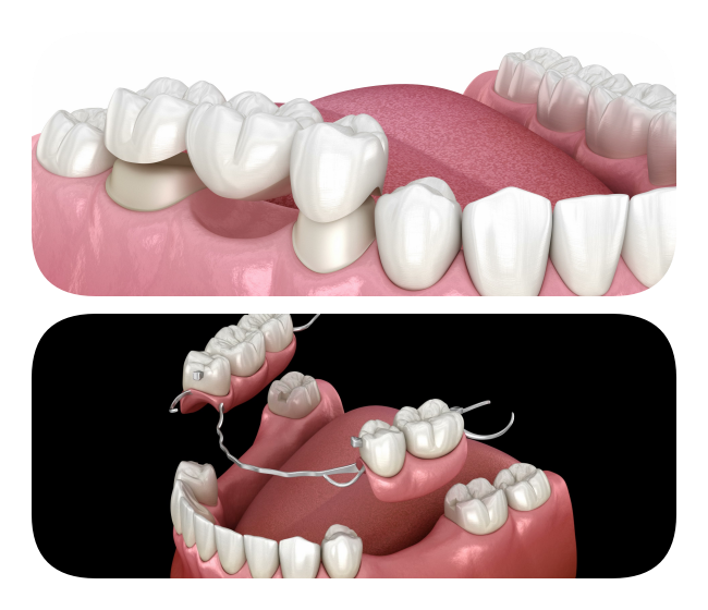 Witness a 3D visualization of bespoke dental bridges available at Glenn Smile Center.