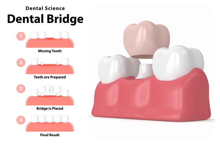 Peruse a well-crafted diagram explaining the intricacies of dental bridge treatment at Glenn Smile Center.