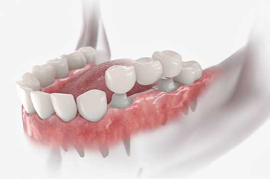 Observe the intricate 3D model that simulates dental bridge services at Glenn Smile Center.