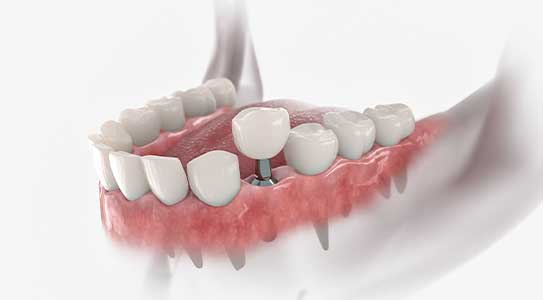 A detailed 3D model showcases the precision of Glenn Smile Center's dental crown services.