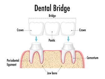 Inspect the visual guide detailing every stage of the dental bridge treatment offered by Glenn Smile Center.