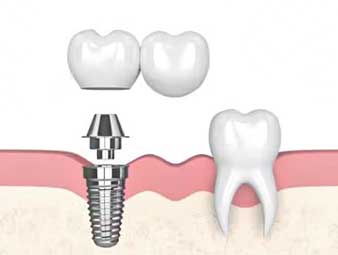 Discover a 3D model showcasing the dental bridges offered at Glenn Smile Center.