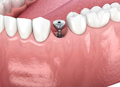 A scale model of dental implants is part of a mockup display at Glenn Smile Center.