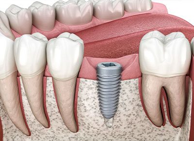 Glenn Smile Center has a mockup that provides a visual representation of dental implants.